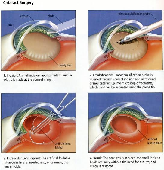 Cataract-Surgery-in-Thane