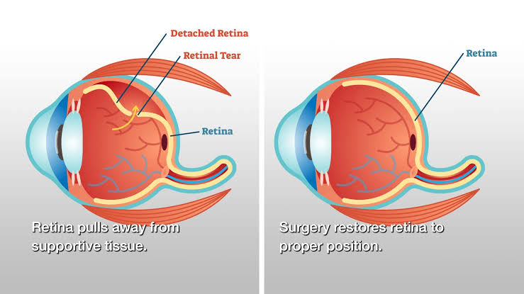 Retinal-surgery-in-thane